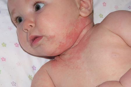 Causes, symptoms and treatment of prickly heat in newborns