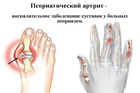 Causes, symptoms and treatment of psoriatic arthritis