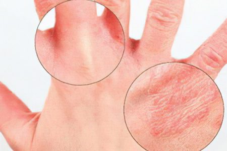 Causes, symptoms and treatment of psoriatic arthritis