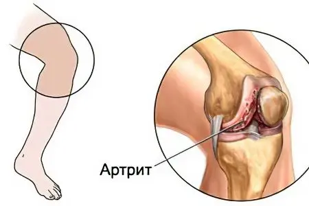 Causes, symptoms and treatment of purulent arthritis