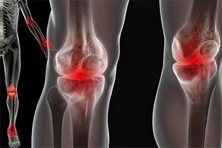 Causes, symptoms and treatment of reactive arthritis