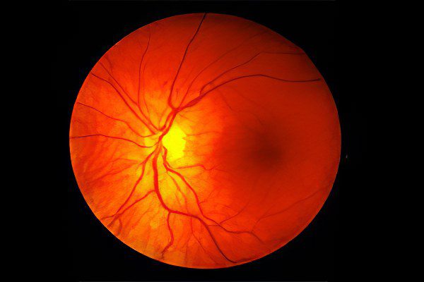 Causes, symptoms and treatment of retinal angiopathy