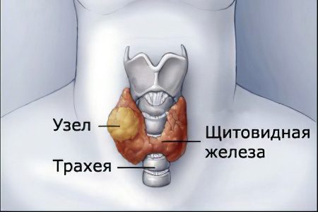 Causes, symptoms and treatment of thyroid nodules. Why are they dangerous?