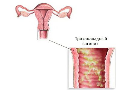 Causes, symptoms and treatment of vaginitis