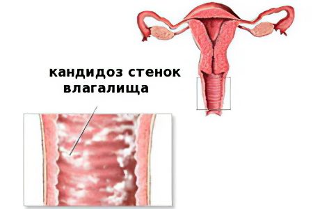 Causes, symptoms and treatment of vaginitis