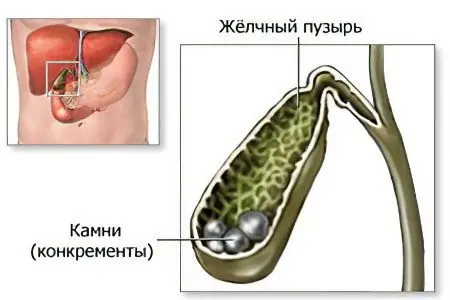 Causes, symptoms and treatments for gallstones