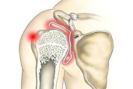 Causes, symptoms and treatments for shoulder arthritis