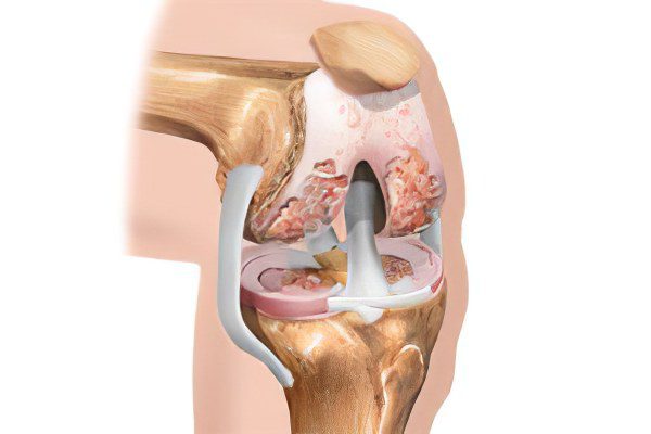 Causes, symptoms, degrees and treatment of osteoarthritis of the knee