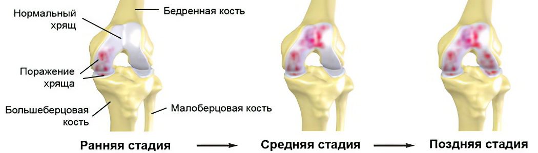 Causes, symptoms, degrees and treatment of osteoarthritis of the knee