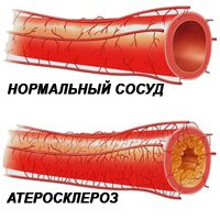 Causes, symptoms, diagnosis and treatment of atherosclerosis