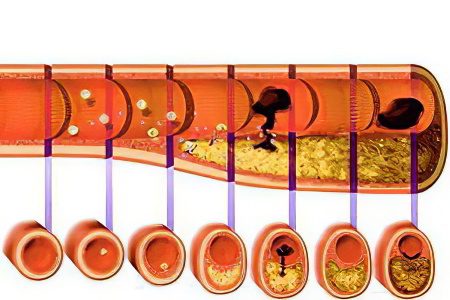 Causes, symptoms, diagnosis and treatment of atherosclerosis