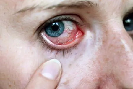 Causes, symptoms, eye drops for redness of the eyes