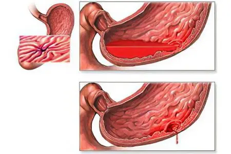 Causes, symptoms, first aid and diagnosis of gastrointestinal bleeding