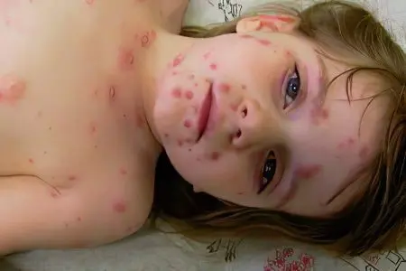 Causes, symptoms, forms and treatment of purulent chickenpox