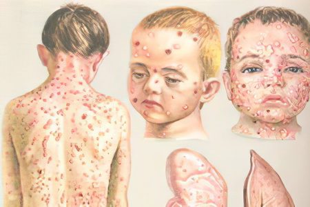 Causes, symptoms, forms and treatment of purulent chickenpox