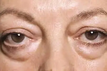 Causes, symptoms, how to remove swelling under the eyes?