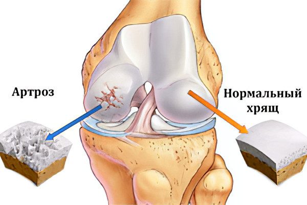 Causes, symptoms of arthrosis, its complications and treatment methods