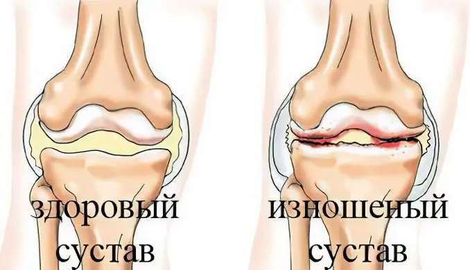 Causes, symptoms of arthrosis, its complications and treatment methods