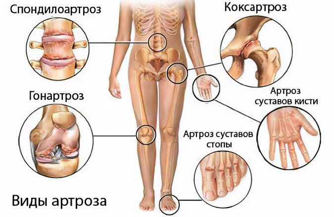 Causes, symptoms of arthrosis, its complications and treatment methods