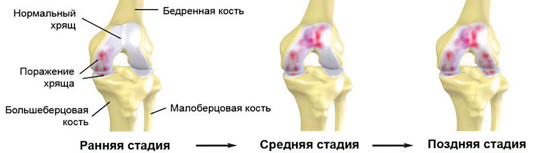 Causes, symptoms of arthrosis, its complications and treatment methods