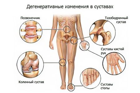 Causes, symptoms of arthrosis, its complications and treatment methods