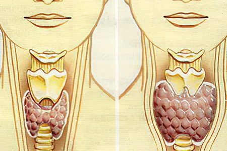 Causes, symptoms of hypothyroidism, how to treat?