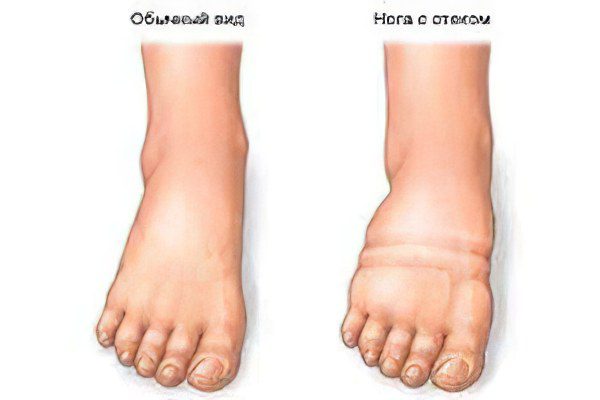 Causes, symptoms of swelling of the legs, how to remove?