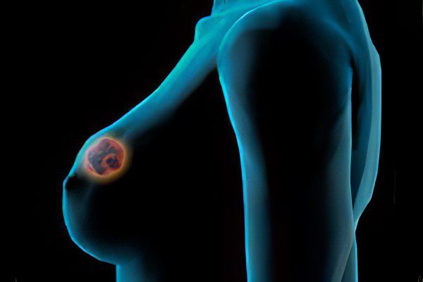 Causes, symptoms, stages and treatment of breast cancer