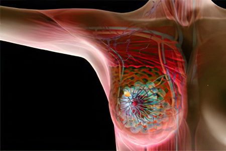 Causes, symptoms, stages and treatment of breast cancer