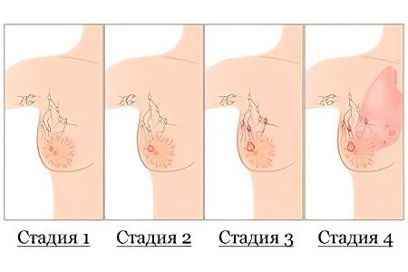 Causes, symptoms, stages and treatment of breast cancer