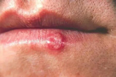 Causes, symptoms, stages and treatment of lip cancer