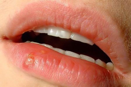 Causes, symptoms, stages and treatment of lip cancer