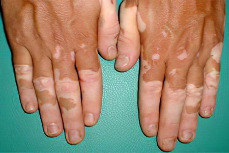 Causes, symptoms, stages, how and how to treat vitiligo?