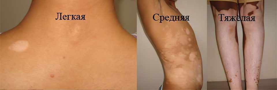 Causes, symptoms, stages, how and how to treat vitiligo?