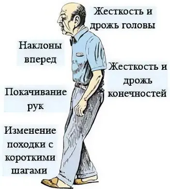 Causes, symptoms, stages, how to treat Parkinsons disease?