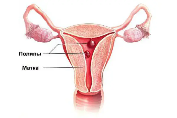 Causes, symptoms, treatment and methods for removing polyps in the uterus