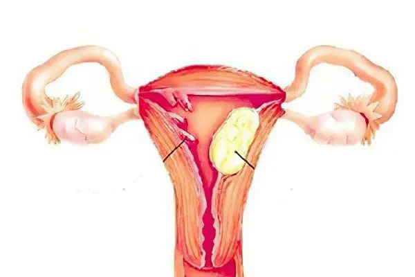 Causes, symptoms, treatment and methods for removing polyps in the uterus