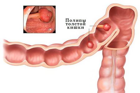 Causes, symptoms, treatment and removal of polyps in the rectum