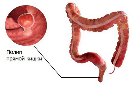 Causes, symptoms, treatment and removal of polyps in the rectum