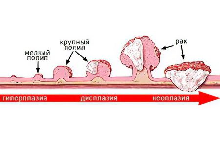 Causes, symptoms, treatment and removal of polyps in the rectum