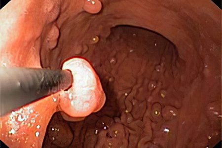 Causes, symptoms, treatment and removal of polyps in the rectum