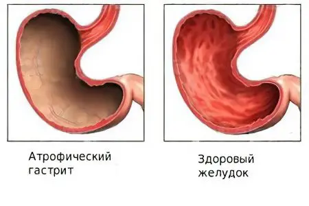 Causes, symptoms, treatment of atrophic gastritis