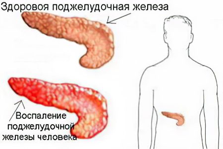 Causes, symptoms, treatment of inflammation of the pancreas