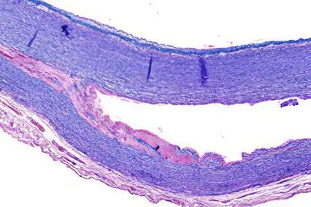 Causes, types and symptoms of aortic dissection