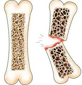 Causes, types of fractures and healing phases