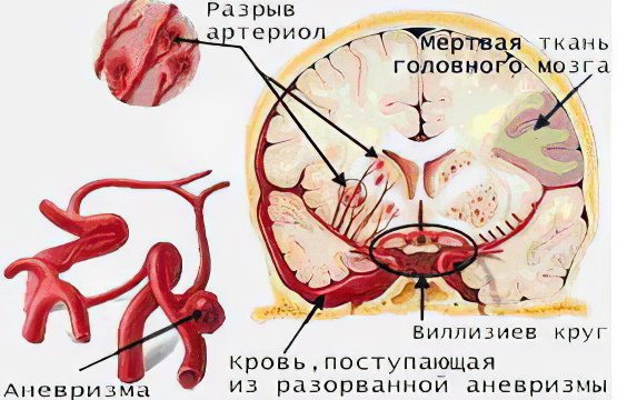 Causes, types, signs and consequences of a stroke