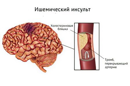 Causes, types, signs and consequences of a stroke