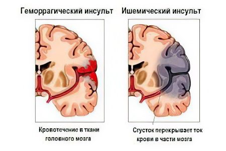 Causes, types, signs and consequences of a stroke