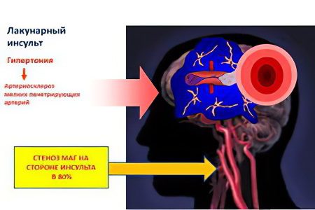 Causes, types, signs and consequences of a stroke