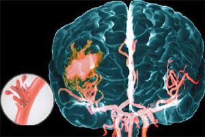 Causes, types, signs and consequences of a stroke